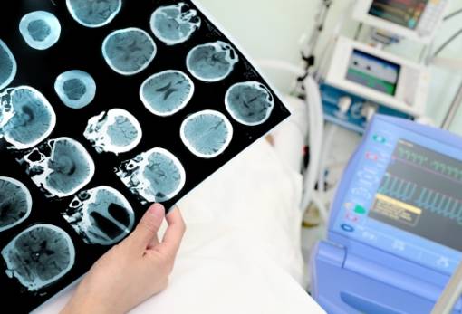 Έρευνα: Αύξηση στα εγκεφαλικά