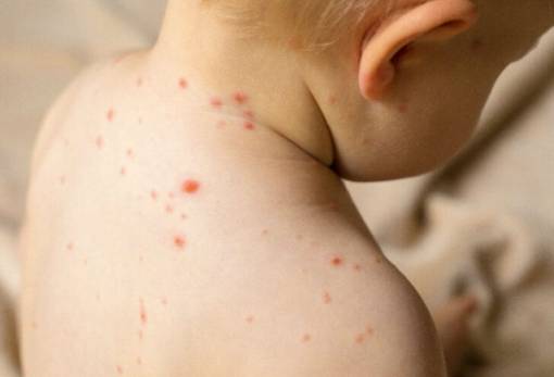 «Συναγερμός» από την απότομη αύξηση κρουσμάτων ιλαράς στην Ευρώπη