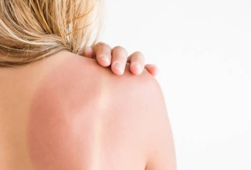 Τips για να απαλλαγείς από το ηλιακό έγκαυμα