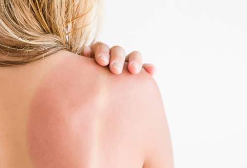 Κάηκες από τον ήλιο; Δες τι πρέπει να κάνεις.