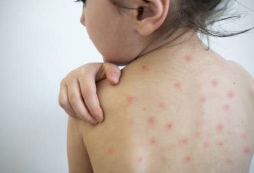 «Συναγερμός» για παγκόσμια έξαρση της Ιλαράς - Πώς επηρεάζει ο κορωνοϊός