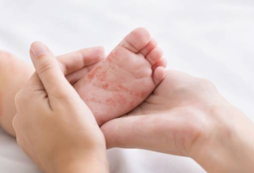 Συναγερμός για την πιθανή αντιμετώπιση επιδημίας ιλαρά