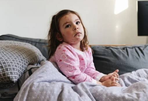 Ιλαρά: «Έκρηξη» κρουσμάτων ακόμη και με μικρή μείωση 1% στους εμβολιασμούς