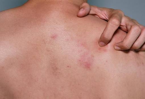 Έρπητας ζωστήρας: Ποιοι πρέπει να εμβολιαστούν