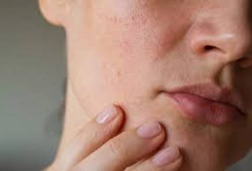 Έχεις λιπαρό δέρμα: Τα καλύτερα tips για το καλοκαίρι